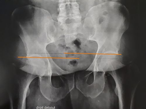 traitement inégalité longueur podologie