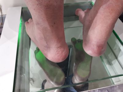 pied varius podologie ruffec