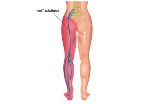 cuisse sciatique douleur podologie ruffec
