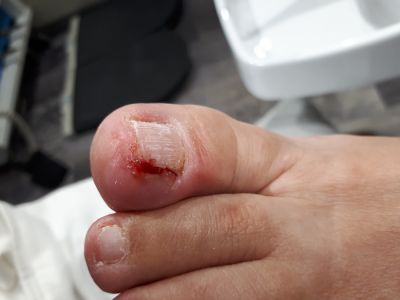 ongle incarné pédicurie ruffec