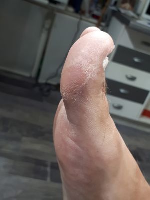 hallux flexus podologie ruffec