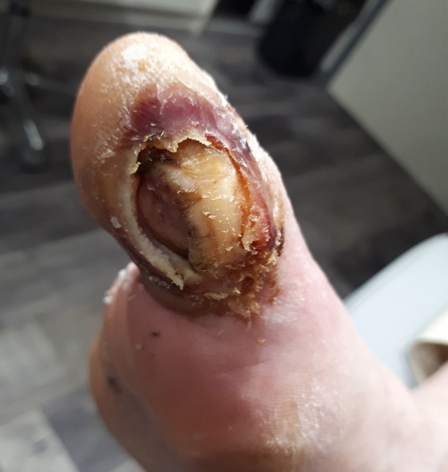 mal perforant ruffec