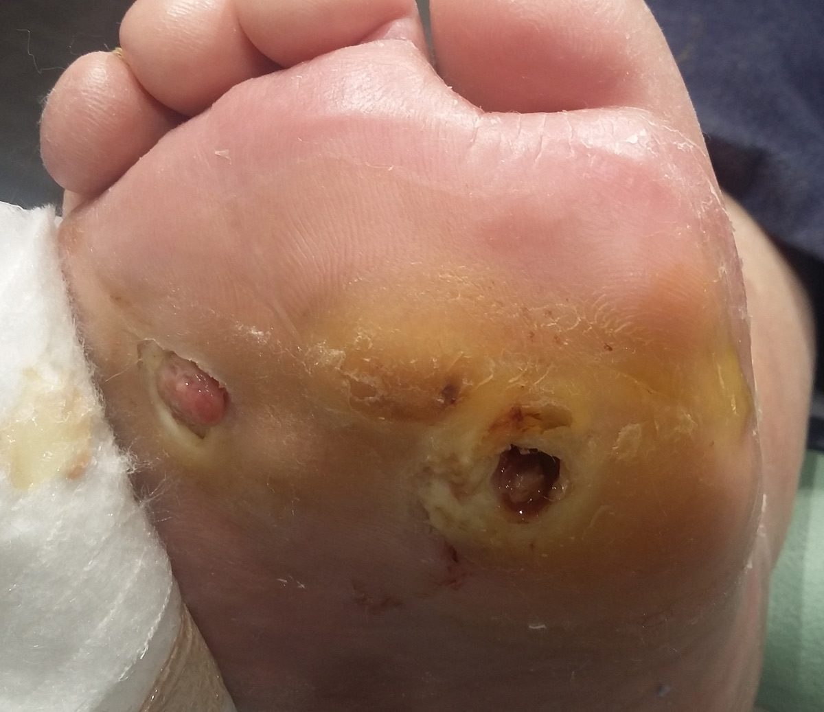 mal perforant ruffec