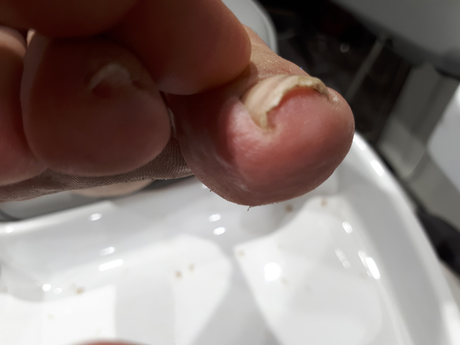 ongle incarné pédicurie ruffec