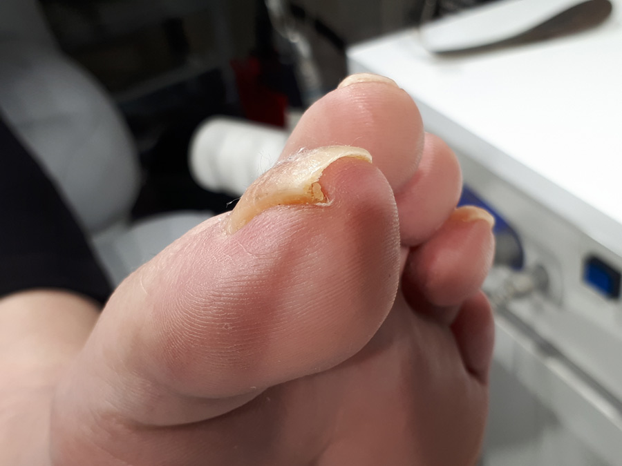 ongle incarné pédicurie ruffec