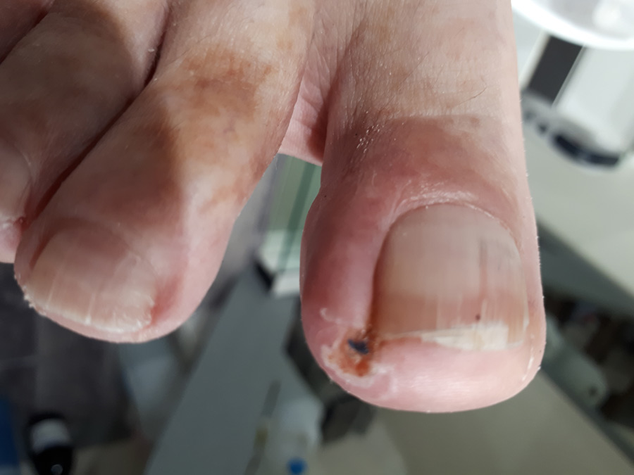 ongle incarné pédicurie ruffec