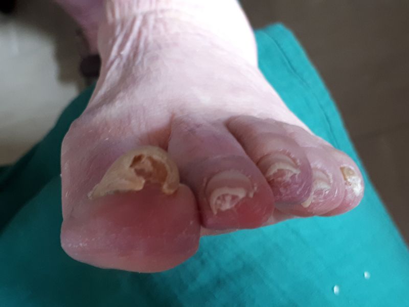 ongle incarné pédicurie ruffec