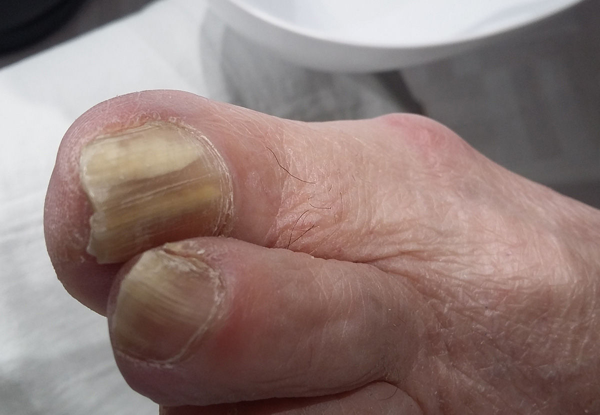 onychomycose ruffec podologue