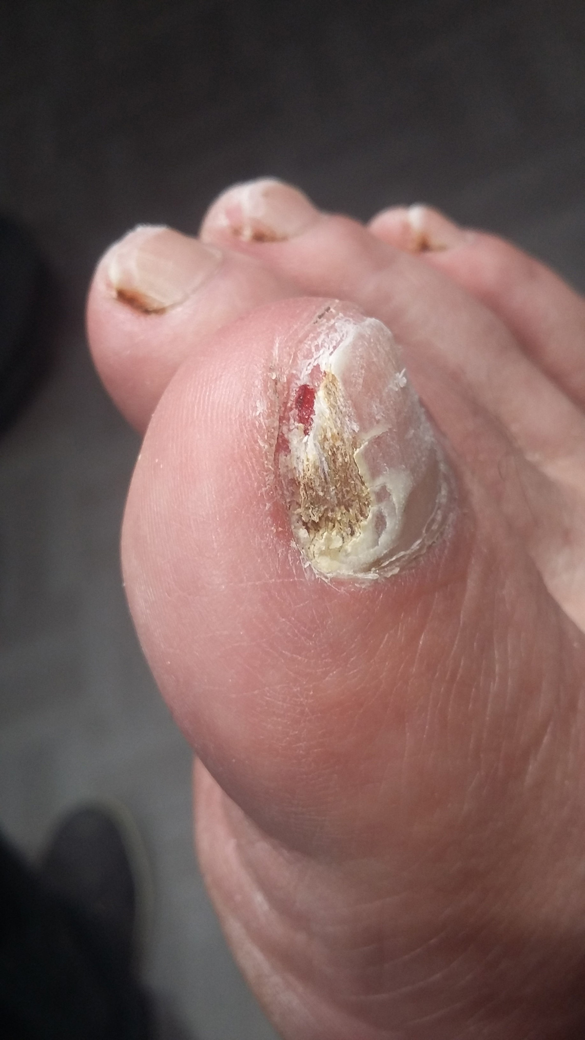 onychomycose ruffec podologue