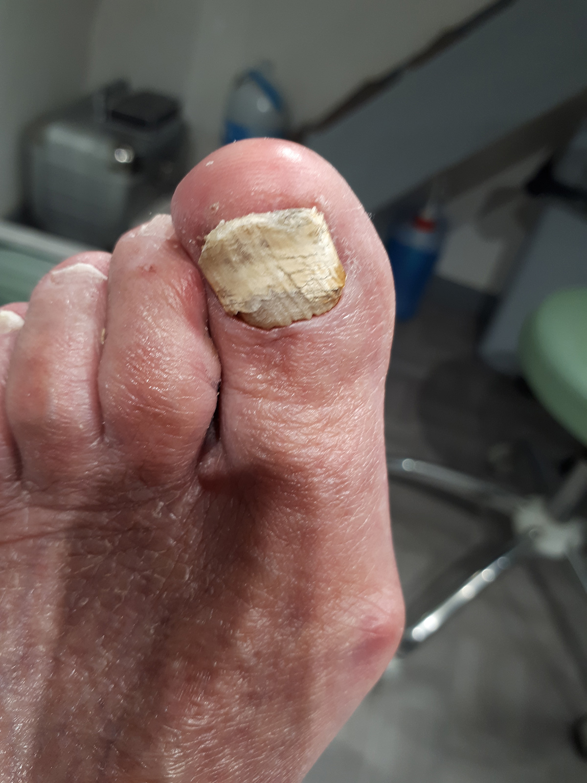 onychomycose ruffec podologue