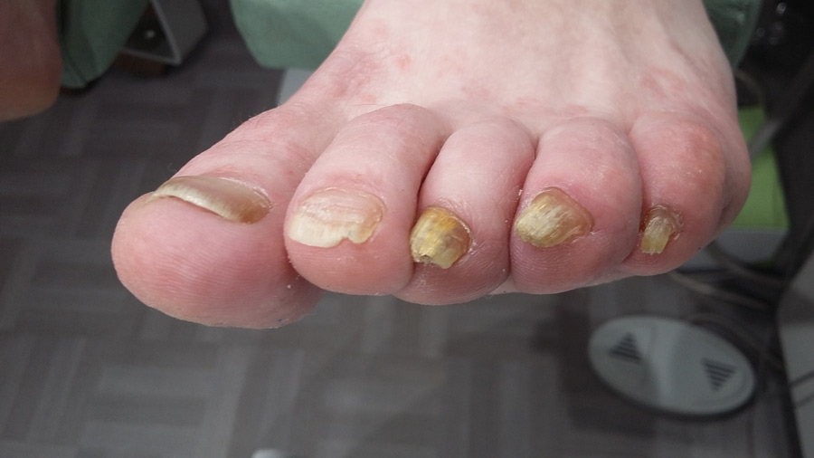 onychomycose ruffec podologue