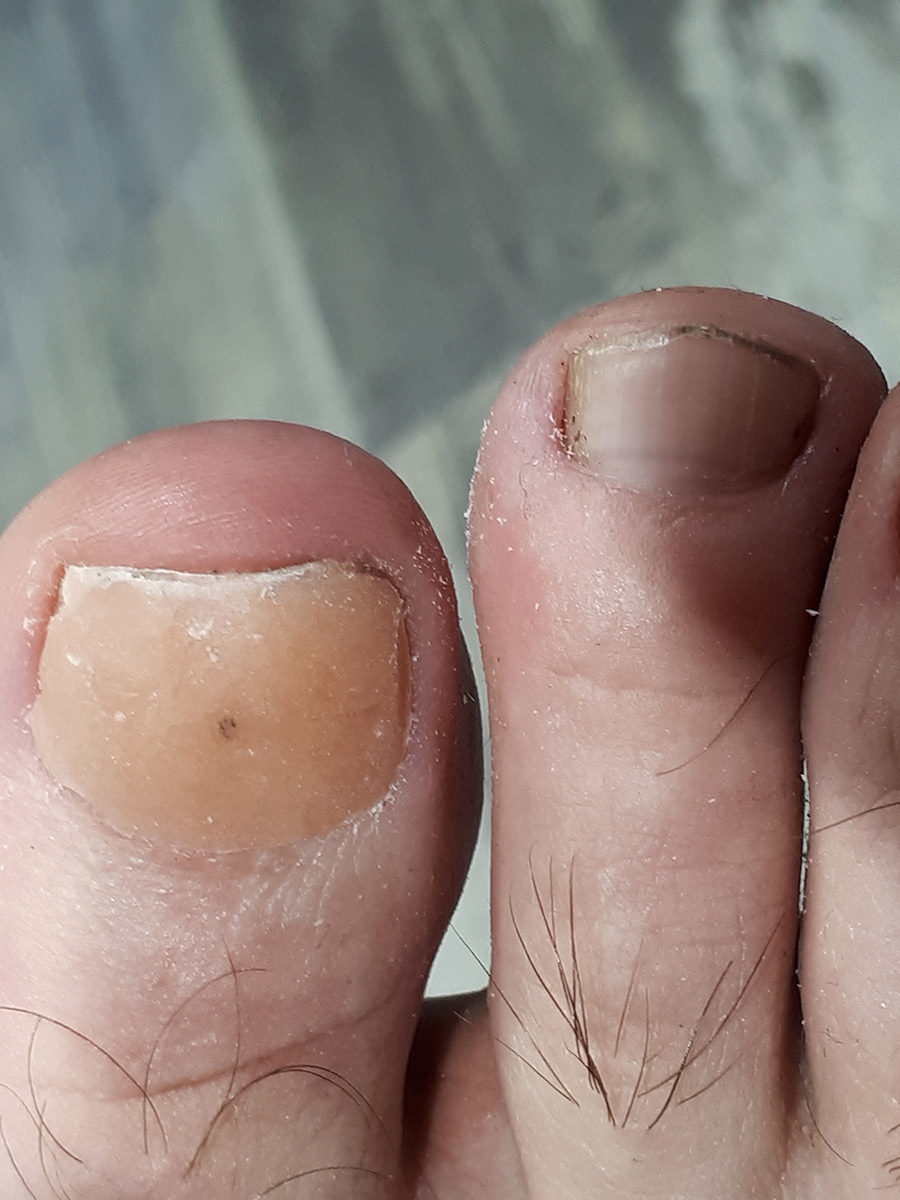 onychoplastie ruffec podologue