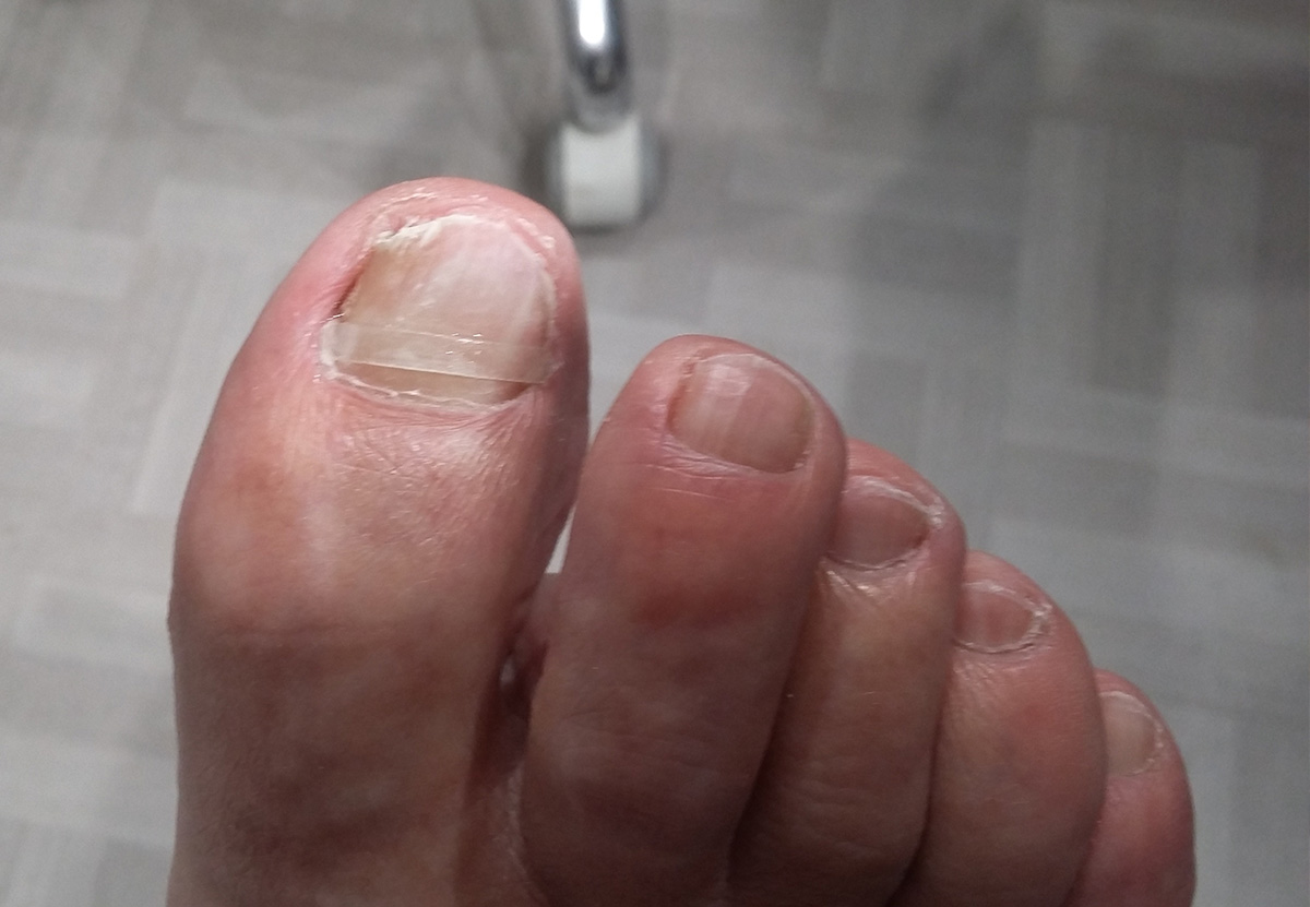 orthonyxie ruffec podologue