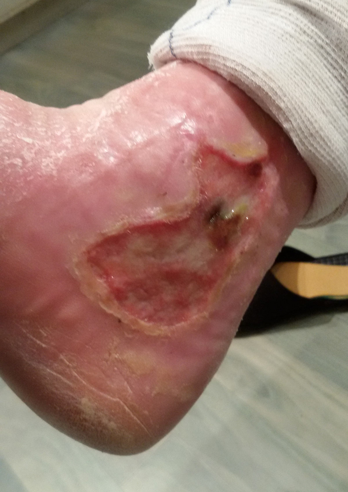 ulcere maux perforant podologie ruffec