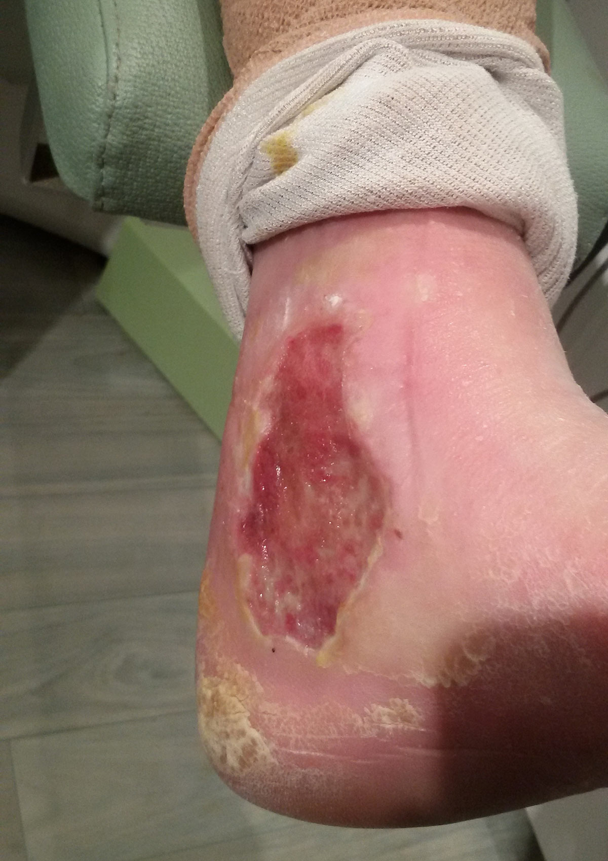 ulcere maux perforant podologie ruffec