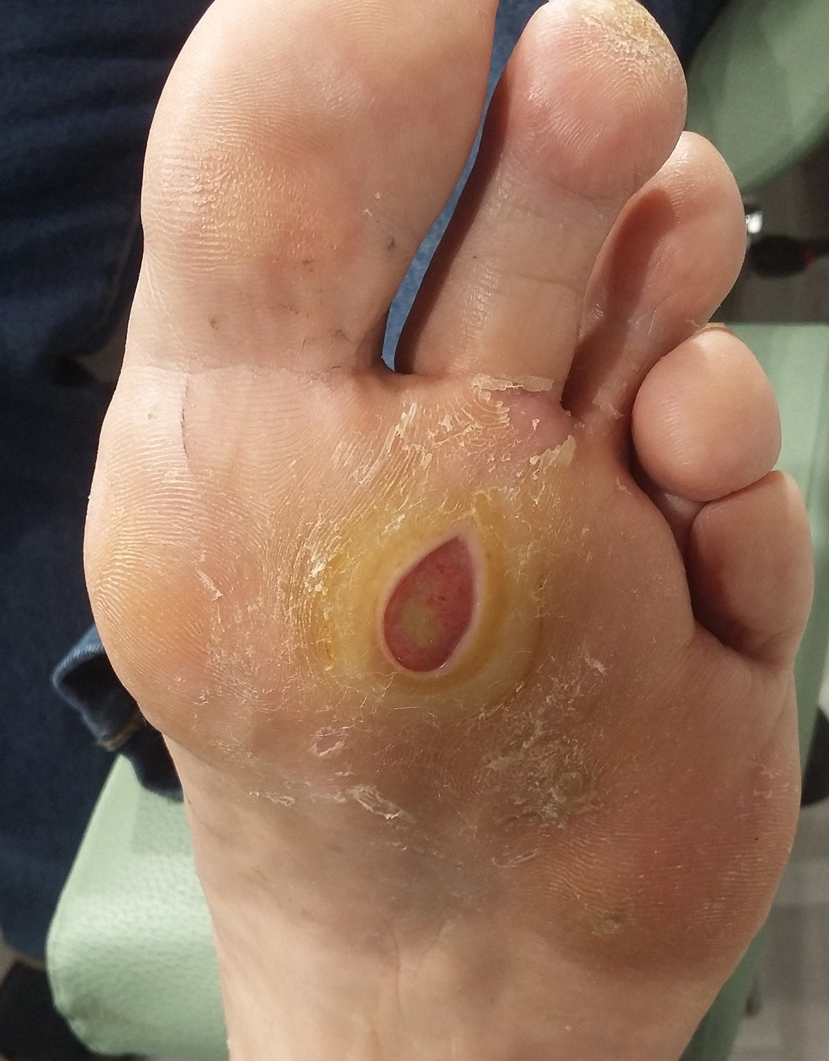 mal perforant ruffec