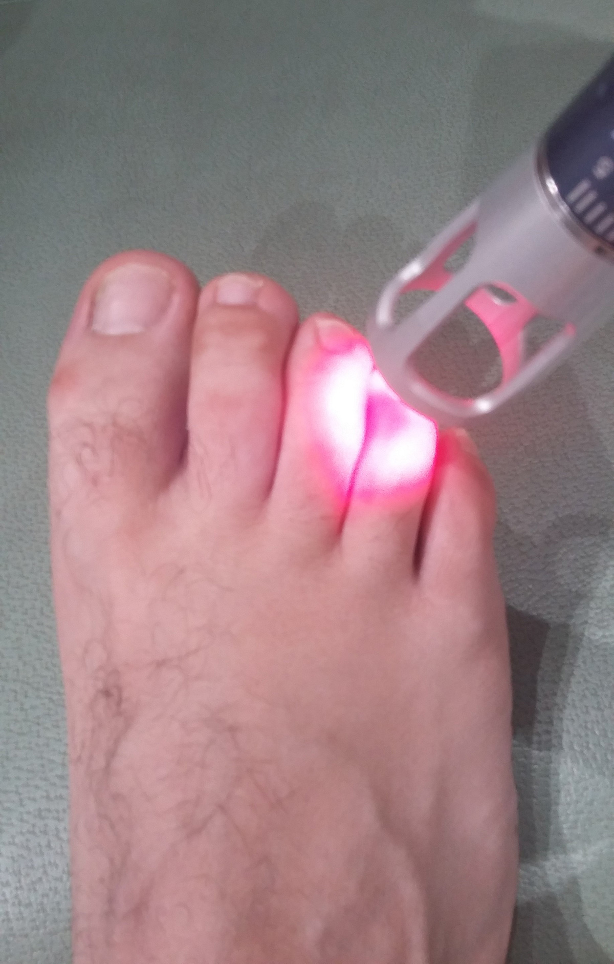 thérapie laser podologie ruffec