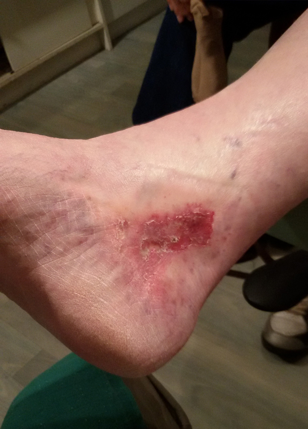 Ulcère avant traitement