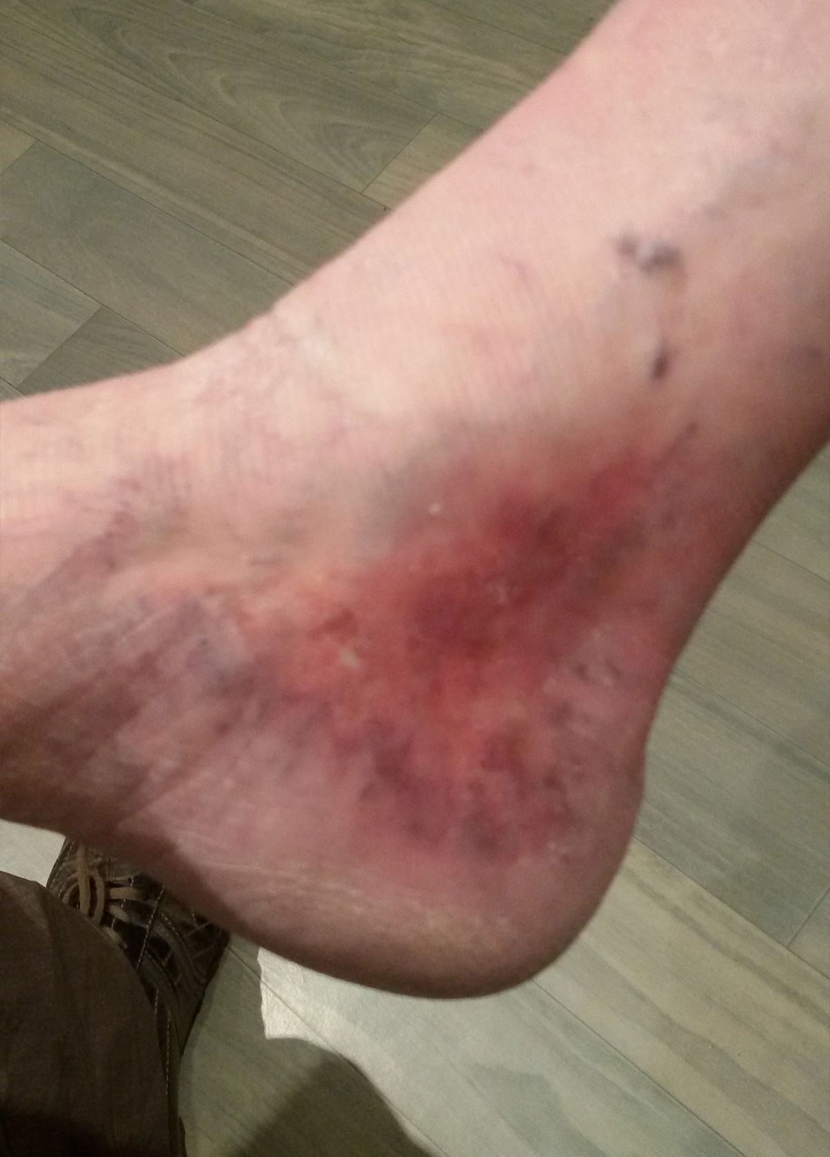 Ulcère en fin de traitement